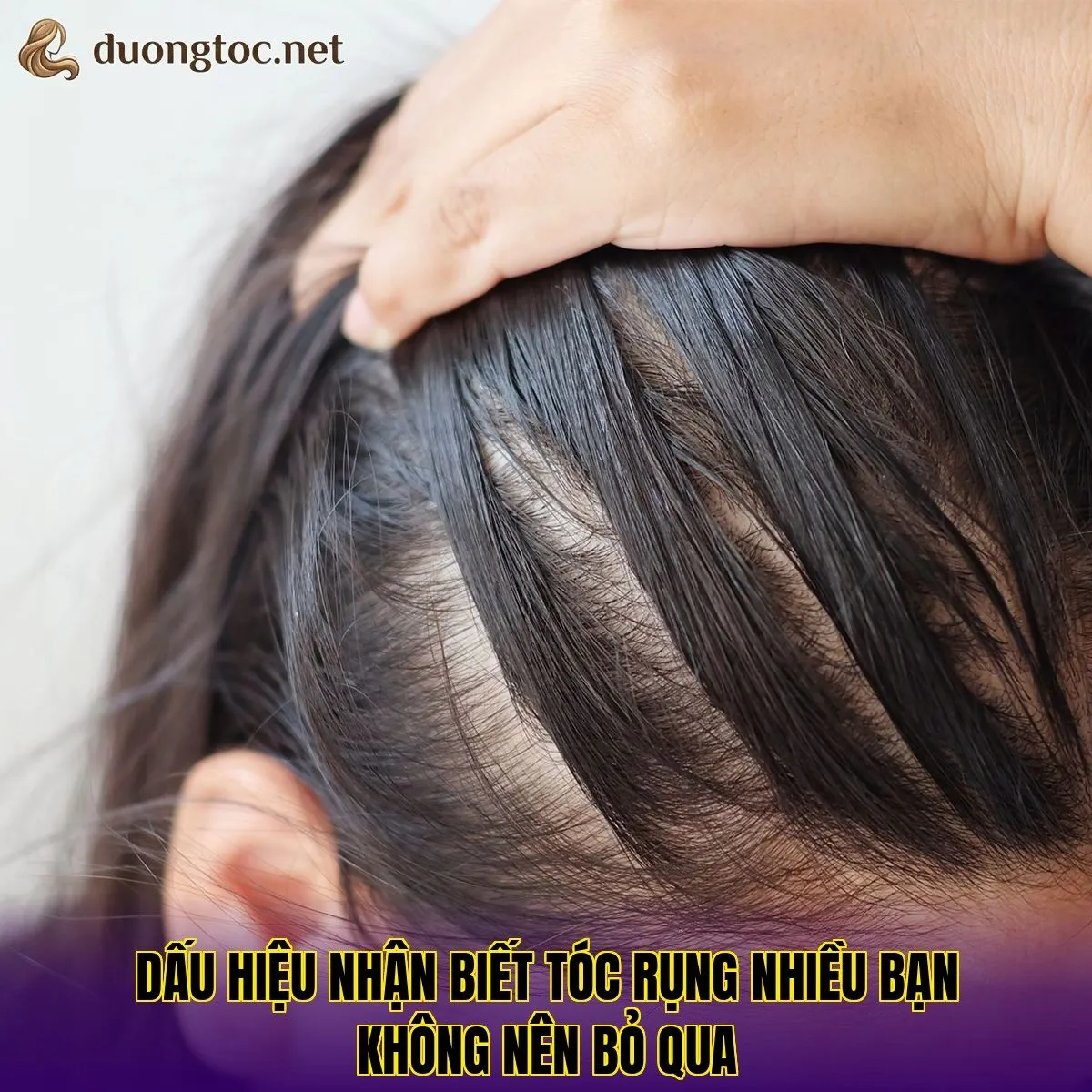 Dấu hiệu nhận biết tóc rụng nhiều bạn không nên bỏ qua